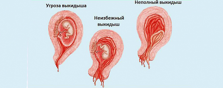 Как Выглядит Выкидыш Фото