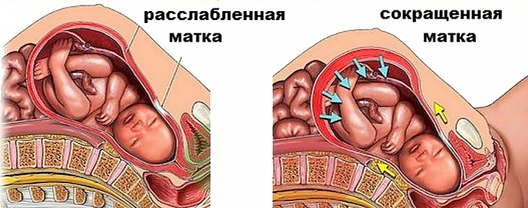 Матка При Беременности На Ранних Сроках Фото